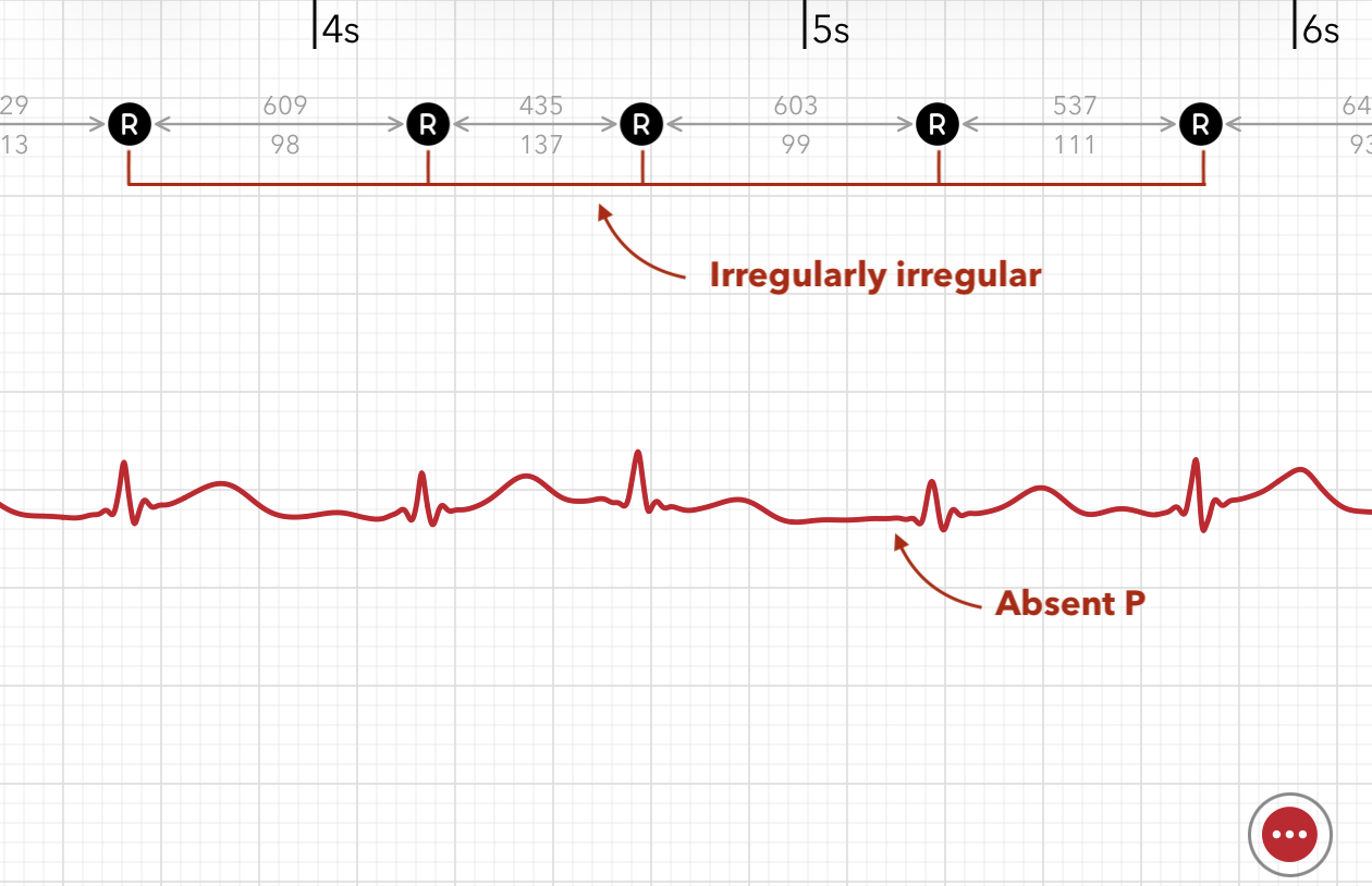 ECG+ app showing atrial fibrillation captured on an Apple Watch ECG recording