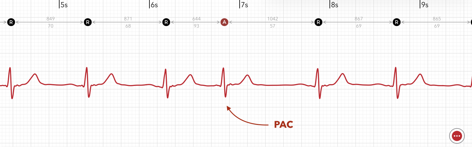 ECG+ app identifying a premature atrial contraction (PAC) on an Apple Watch ECG recording
