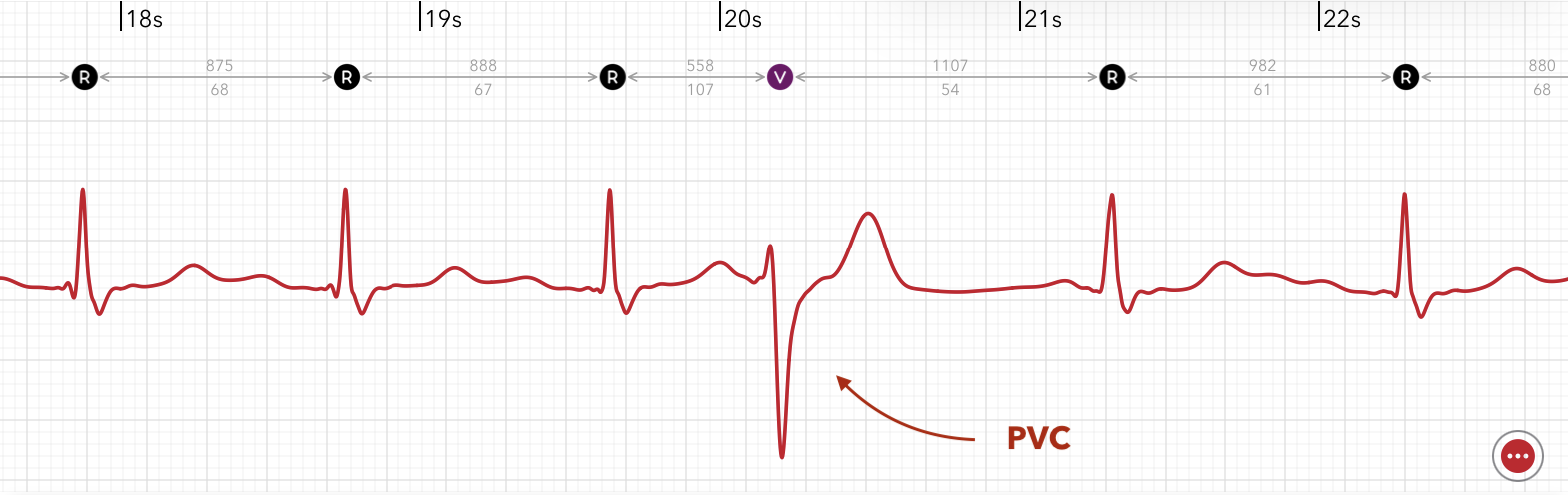 ECG+ app identifying a premature ventricular contraction (PVC) on an Apple Watch ECG recording