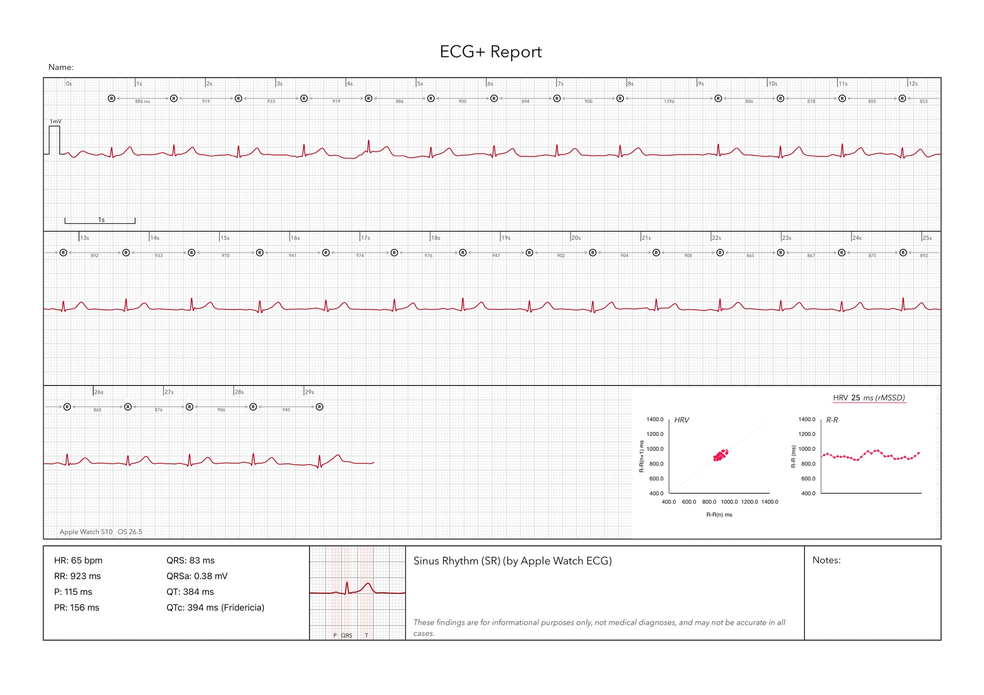 An ECG+ report showing a Sinus Rhythm (SR) result from an Apple Watch ECG, with heart rate, PR, QT and QTc measurements