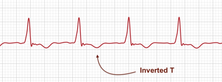 ECG+ app showing an inverted T wave on an Apple Watch ECG recording