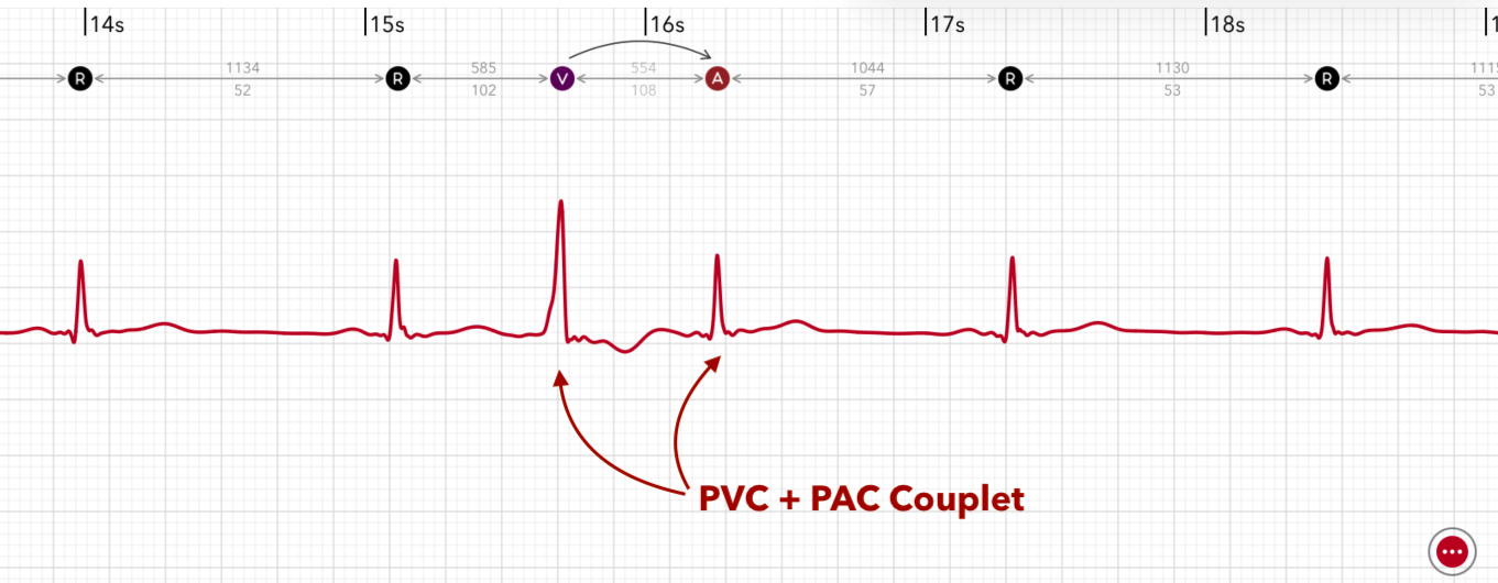ECG+ app showing PAC and PVC couplets — two premature beats in a row on an Apple Watch ECG