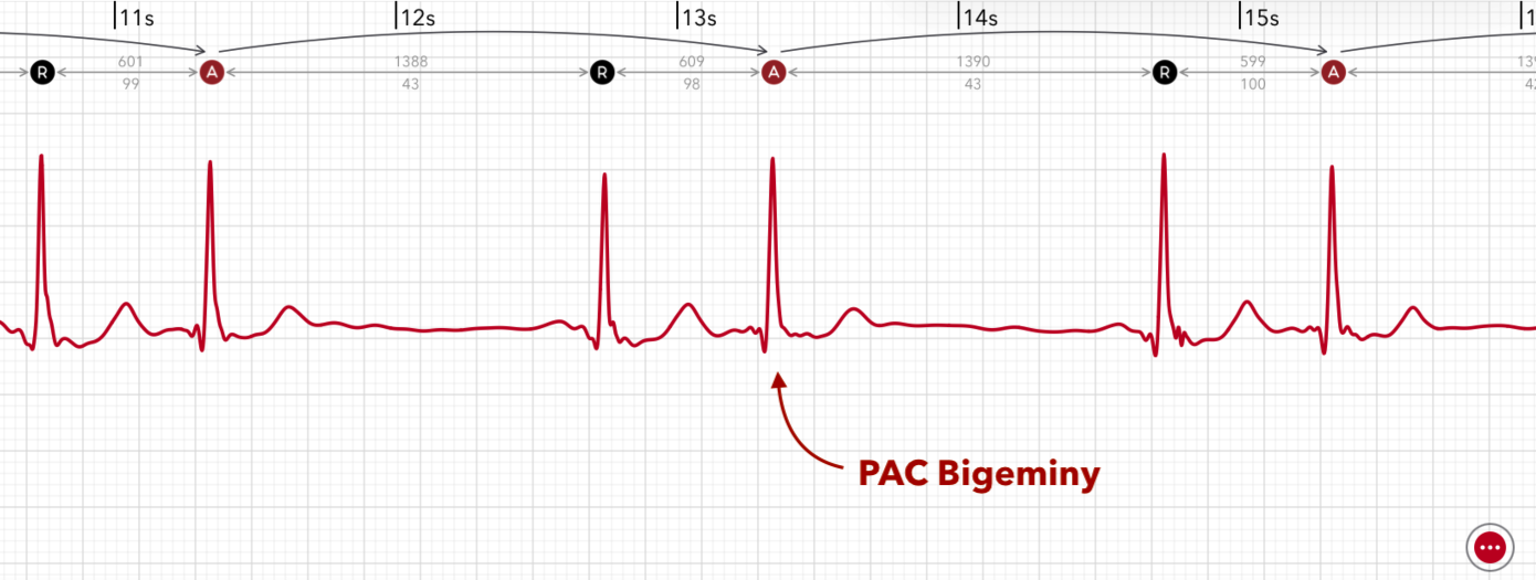 ECG+ app showing PAC bigeminy — every second beat is a premature atrial contraction on an Apple Watch ECG