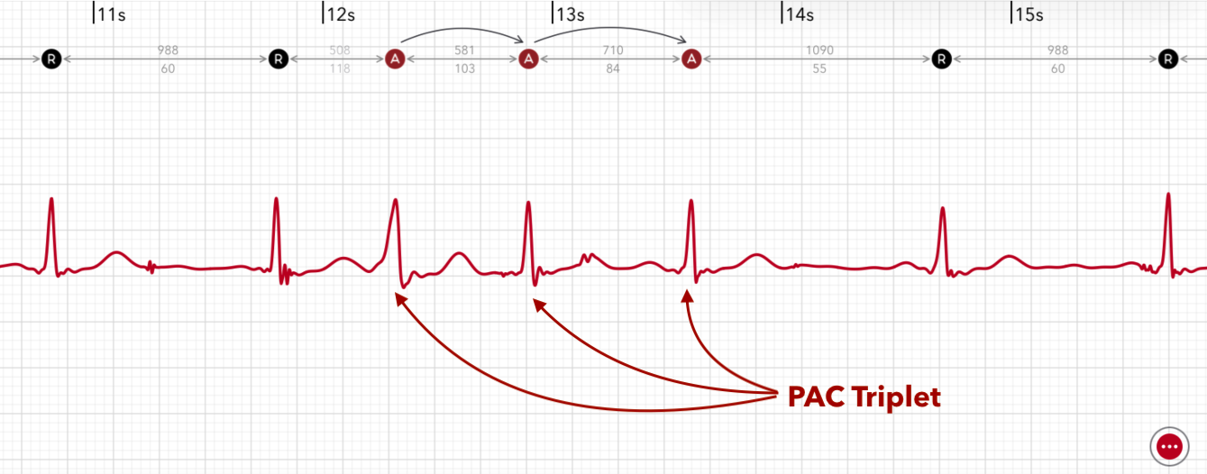 ECG+ app showing a PAC triplet — three premature beats in a row on an Apple Watch ECG