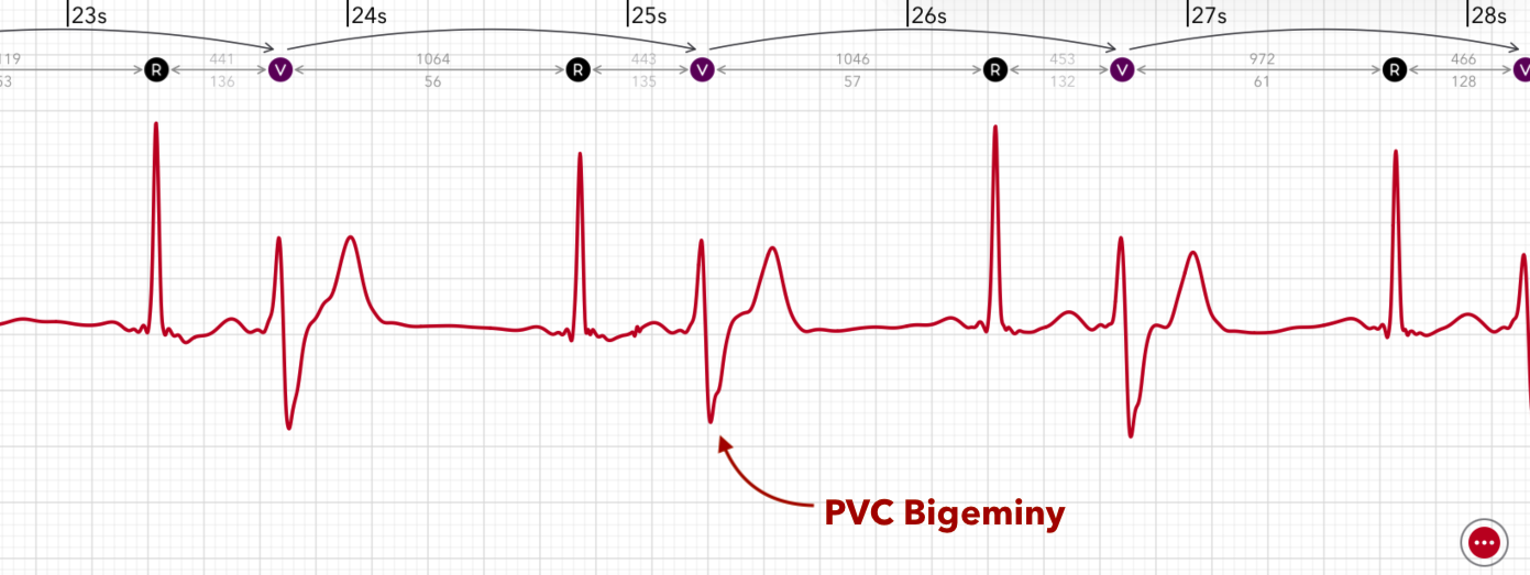 ECG+ app showing PVC bigeminy — every second beat is a premature ventricular contraction on an Apple Watch ECG
