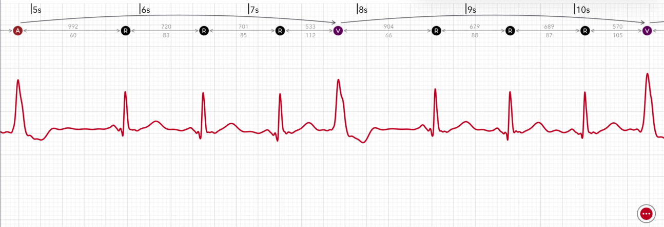 ECG+ app showing PVC quadrigeminy — every fourth beat is a premature ventricular contraction on an Apple Watch ECG