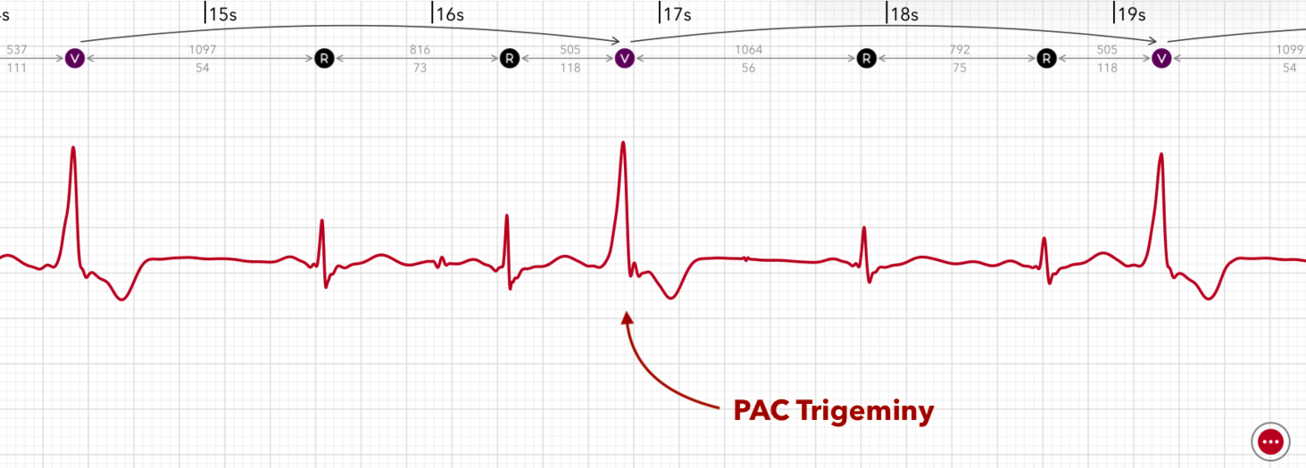 ECG+ app showing PVC trigeminy — every third beat is a premature ventricular contraction on an Apple Watch ECG