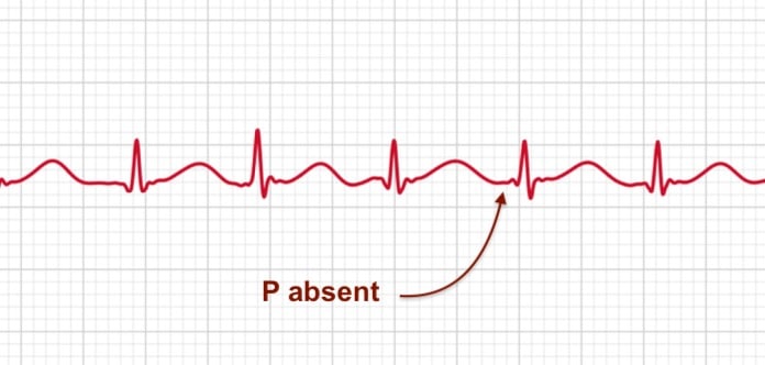 ECG strip showing atrial fibrillation with an arrow pointing to an absent P wave in ECG+ app