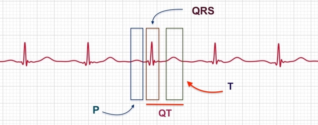 Apple Watch ECG wave diagram labeling the P wave, QRS complex, T wave, and QT interval in ECG+ app