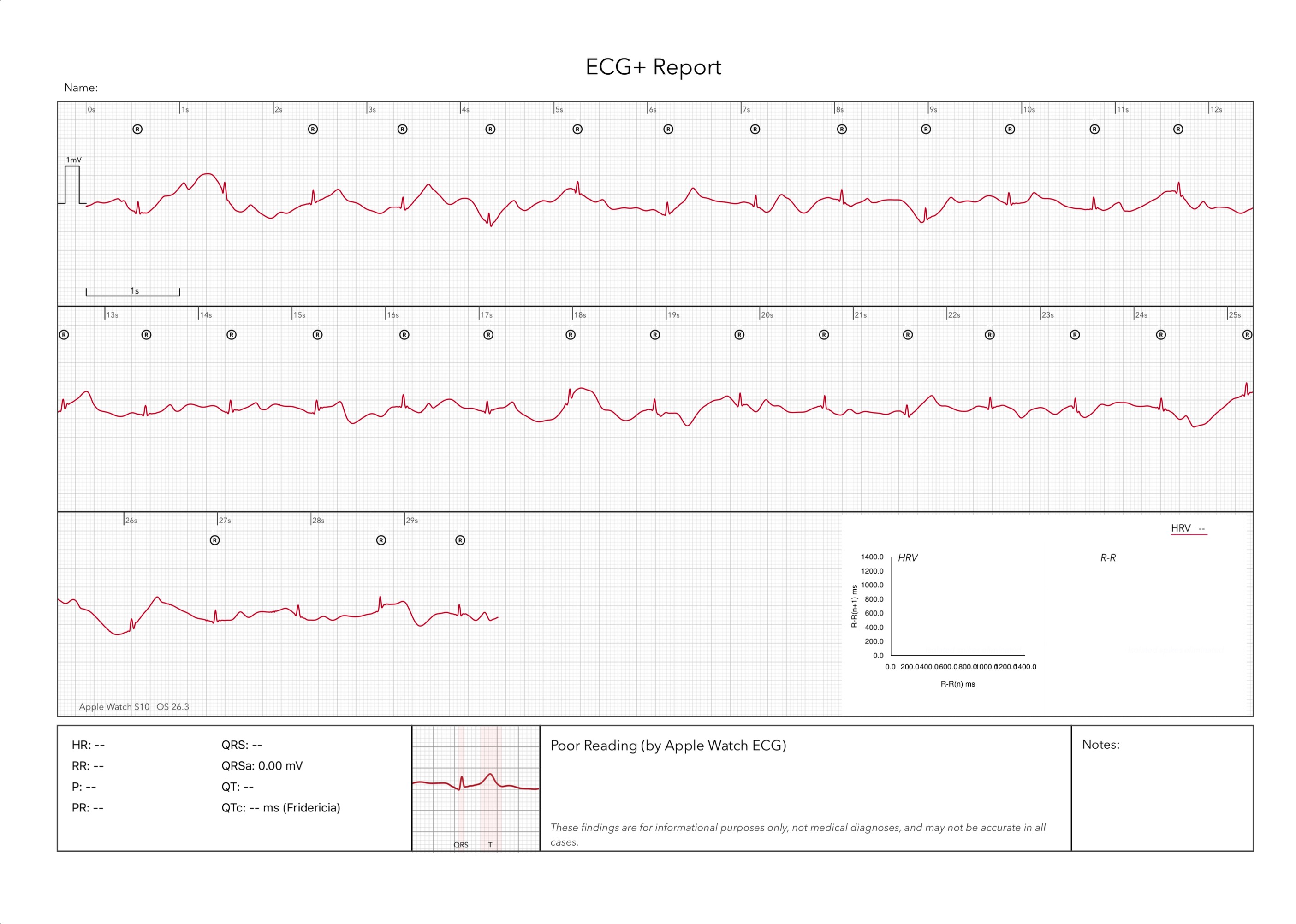 A poor recording result on an Apple Watch ECG