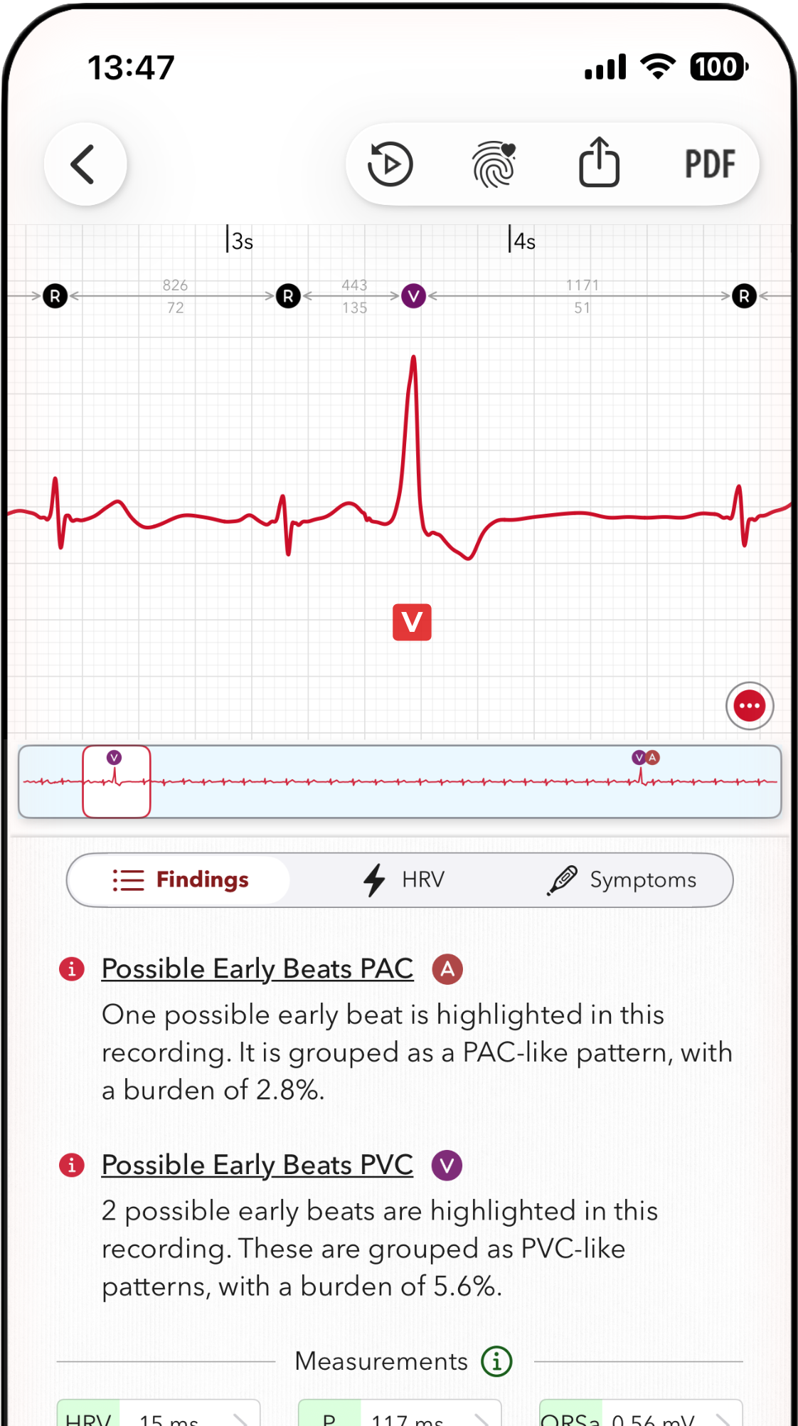 ECG+ app screenshot showing a PVC beat is marked on an Apple Watch ECG report