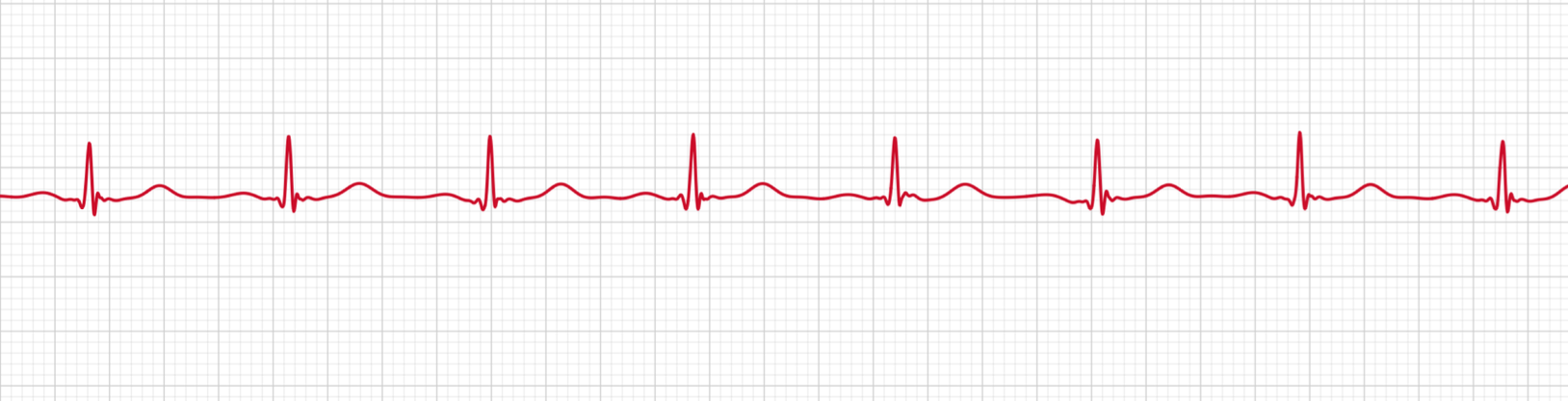 A normal sinus rhythm on an Apple Watch ECG — regular, evenly spaced beats each with an upright P wave